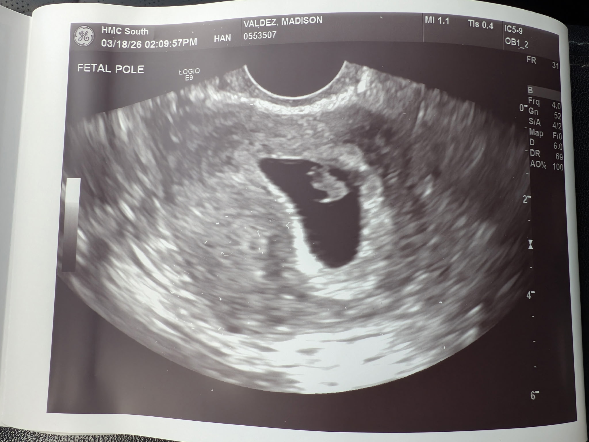 Arm and hand ultrasound
