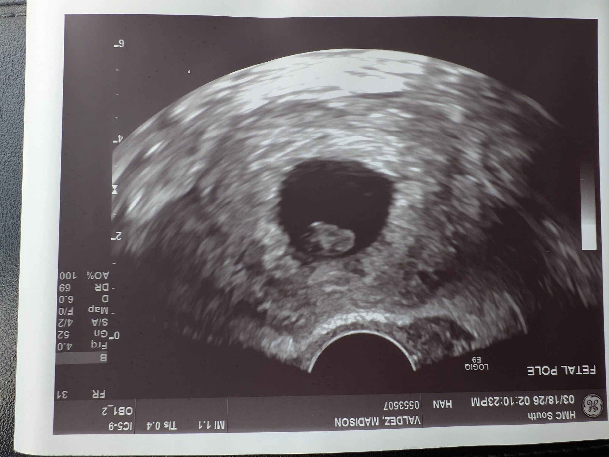 Heartbeat ultrasound