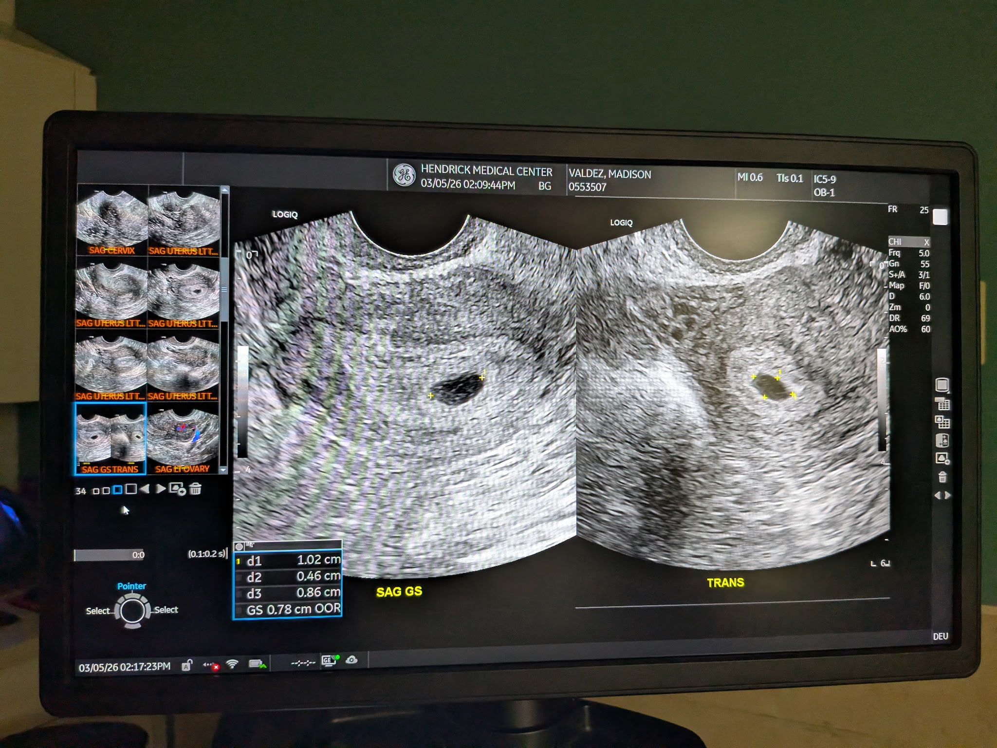 Early ultrasound