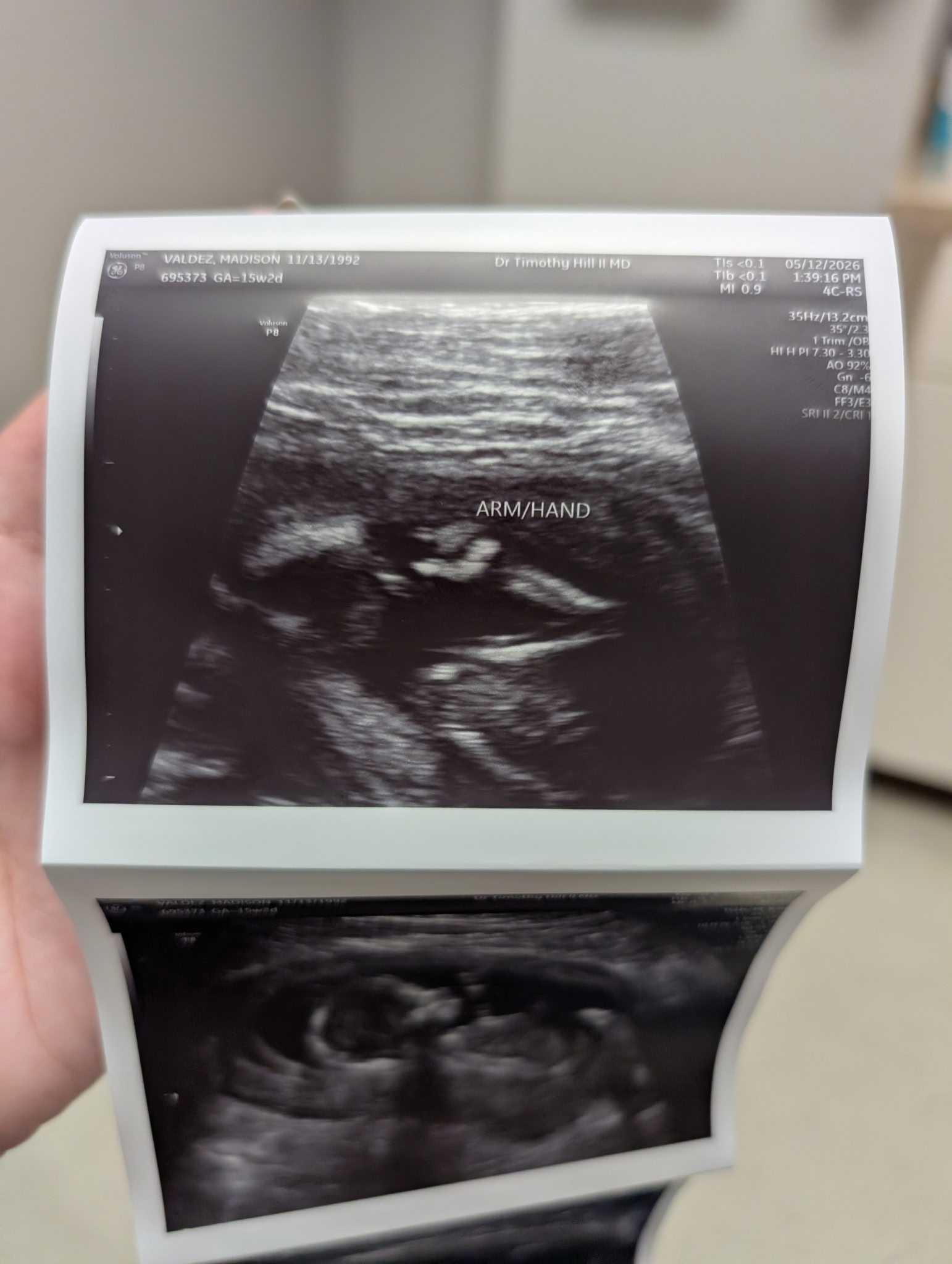 Sweet profile ultrasound